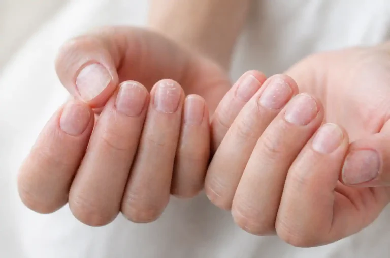 Mains montrant des ongles naturels fragilisés après un ponçage excessif
